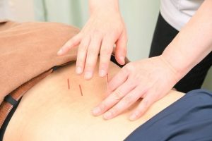 坐骨神経痛の深層筋にアプローチする刺激を抑えた鍼施術(当院写真)